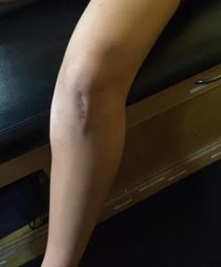 Knee ACL patellar tendon