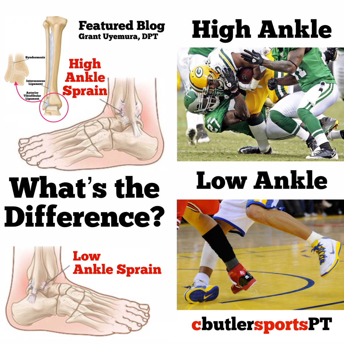 High vs Low Ankle Sprains